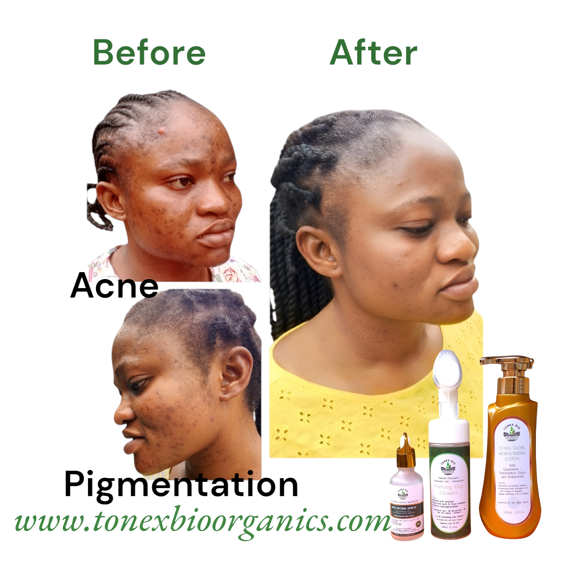 About Tonex Bio Organics acne hyperpigmentation treatment set